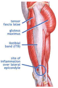 IT band pain site with TFL and glutes
