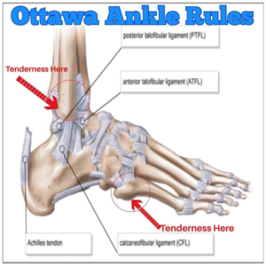 Elevate’s Ankle Sprain Rehab – Elevate Physical Therapy & Fitness