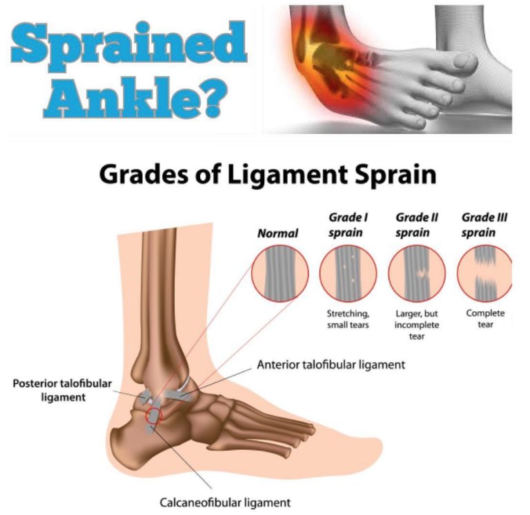 Elevate’s Ankle Sprain Rehab – Elevate Physical Therapy & Fitness